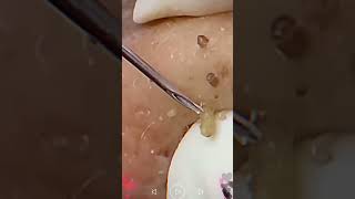 Skincare  Blackheads Removal 182 skincare skincare blackheads blackheads [upl. by Nnylf]