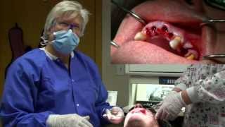 Physics Forceps Immediate Implant Placement Grafting tooth extraction overdenture [upl. by Irovi853]