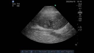 Volumineux Hématome musculaire Vaste interne Quadriceps Echographie [upl. by Eiram183]