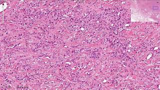 Lobular Carcinoma Breast  Histopathology [upl. by Aekan]