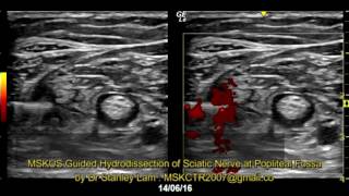 MSKUS Guided Hydrodissection of Sciatic Nerve in Popliteal Fossa [upl. by Heywood]