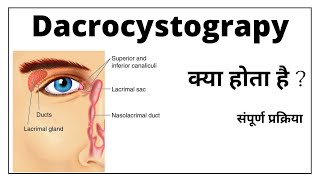 Dacrocystography प्रकिया क्या होती है  और कैसे की जाती है सम्पूर्ण जानकारी [upl. by Elitnahc]