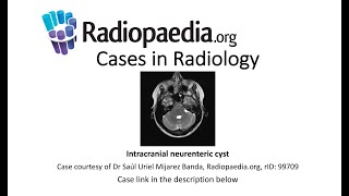 Intracranial neurenteric cyst Radiopaediaorg Cases in Radiology [upl. by Ihsoyim]