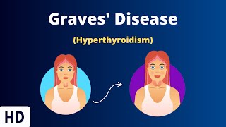 Graves Disease Everything You Need To Know [upl. by Ingemar765]