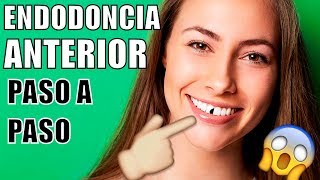 ENDODONCIA EN EL DIENTE DELANTERO ME ROMPÍ UN DIENTE COMO ES UNA ENDODONCIA COMO MTAR EL NERVIO [upl. by Oiludbo]