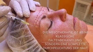 Mesotherapie mit Hyaluronsäure  Behandlung Vorher Nachher [upl. by Immac]