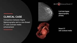 Breast CT with contrast media in comparison to Mammography [upl. by Zetnod776]