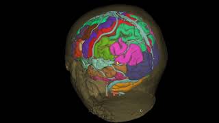 Cavernoma parietal [upl. by Cilurzo]