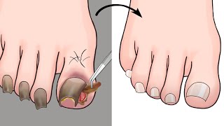 ASMR Ingrown Toenail Removal Treatment Animation  ENJO Relaxing [upl. by Landa1]