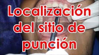 Tecnicas de anestesia en odontologia [upl. by Maximilien448]