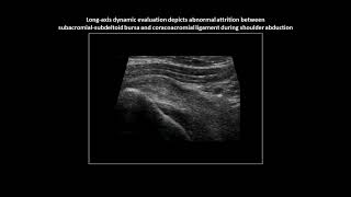 Subacromial impingement on dynamic realtime shoulder ultrasound case 5 [upl. by Merrielle]