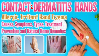 Contact dermatitis hands types causes symptoms treatment home remedy  eczema on hands [upl. by Roer528]