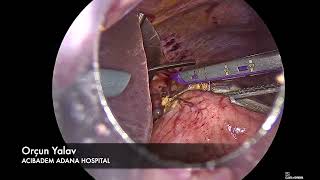 Laparoscopic Proximal Gastrectomy with Double Tract Anastomosis [upl. by Theo]