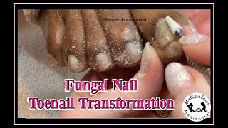 Pedicure Tutorial Thick Fungal Toenail Transformation [upl. by Anigroeg770]