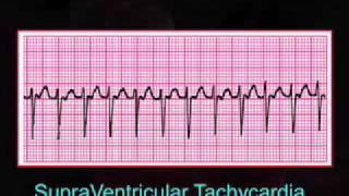 Introduction to EKG Rhythm Interpretation Part 3 [upl. by Bultman]