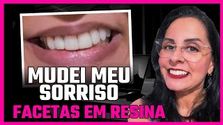 Colocando facetas em resina nos dentes 🦷✨️ [upl. by Ysak]