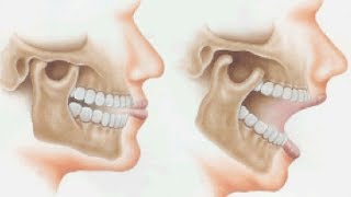 Instructions for Wearing the Upper Maxillary Palatal Biobloc Stage 1 Appliance by Prof John Mew [upl. by Rehpinnej]