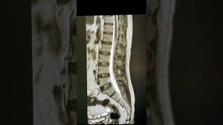 Normal MRI lumbar spine [upl. by Hartzel]