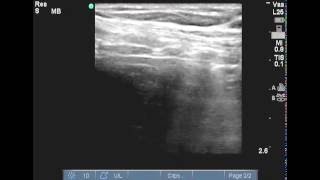 Endotracheal tube retraction 2 under ultrasound guidance prior to percutaneous tracheostomy [upl. by Archy570]