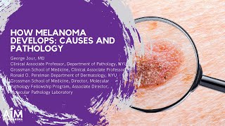 How Melanoma Develops Causes and Pathology [upl. by Ioj972]