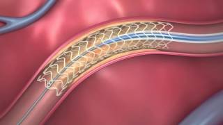 FDAApproved Dissolving Heart Stent  How It Works [upl. by Fellows]