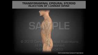 Transforaminal Epidural Steroid Injection Lumbar Spine [upl. by Drucilla]