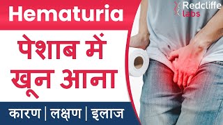 ⛔Hematuria पेशाब में खून आना  Symptoms And Causes in Hindi  ✅ Hematuria Blood in Urine का इलाज [upl. by Scholem210]