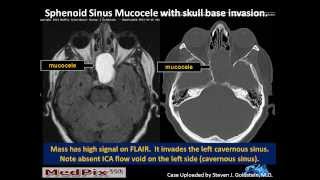 Sphenoid Sinus Mucous Retention Cyst vs Mucocele correction Slide 5 [upl. by Hoy]