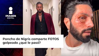 Poncho de Nigris comparte FOTOS golpeado ¿qué le pasó [upl. by Nalon811]