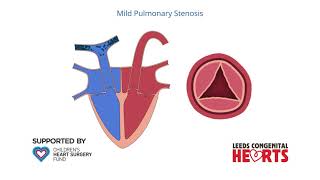 Pulmonary Stenosis [upl. by Akeemahs]