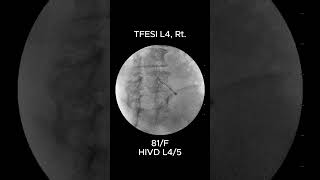 How to Accurately Perform L4 Transforaminal Epidural Steroid Injection TFESI 2 [upl. by Tshombe]