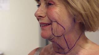 Full Facelift by Dr ThaIn at SkinSurgery Clinics  censored  eindresultaat [upl. by Adorne462]