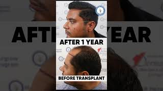 India’s Best Hair Transplant Clinic in Delhi Hairfree Hairgrow Clinic [upl. by Leicam]