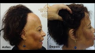 Prótese Capilar Frontal  De Cheveux 11 25945137 [upl. by Noble560]