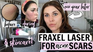 MY FRAXEL DUAL LASER THERAPY RESULTS FOR ACNE SCARS  ONE YEAR AFTER [upl. by Flam]