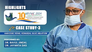 Varicose Veins Venaseal Glue Ablation  10th EUVIC 2024  Dr Ravul Jindal  Dr Jayanta Das [upl. by Ailana737]