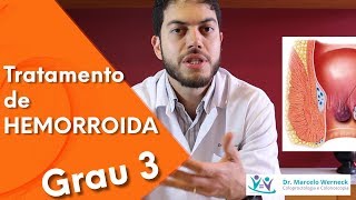 Como é o tratamento de HEMORROIDA grau 3  Dr Marcelo Werneck [upl. by Riddle]