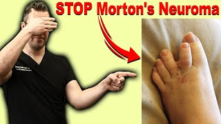 CURE Mortons Neuroma Metatarsalgia amp Ball of the Foot Pain FAST [upl. by Leona]