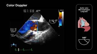 Assessing the aortic valve using TEE midesophageal longaxis view [upl. by Najtsirk457]