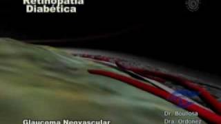 Glaucoma Neovascular en diabetes [upl. by Enialedam10]