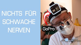 Zahnarzt filmt Weisheitszahn OP mit GoPro Vollnarkose [upl. by Huntlee]