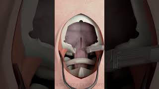 Craniectomy surgery educationalvideo [upl. by Oirretno449]