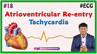 18 Atrioventricular Reentry Tachycardia amp Atrioventricular Nodal Reentrant Tachycardia [upl. by Fuller729]