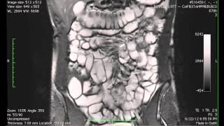 Cine MR imaging of the small intestine in a case of bowel MRI [upl. by Dellora]