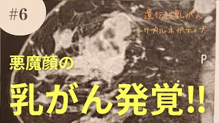 6 悪魔顔の乳がん発覚‼️ 遺伝性乳がん、トリプルネガティブ [upl. by Agem]