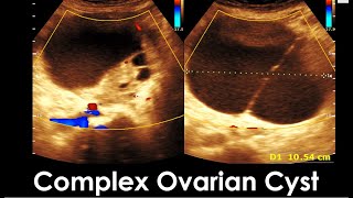 Complex Ovarian Cyst  Cystic and solid adnexal mass  Ovarian tumor [upl. by Enaile]