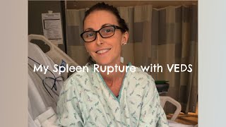 My Spleen Rupture with VEDS Vascular EhlersDanlos syndrome [upl. by Ayet]