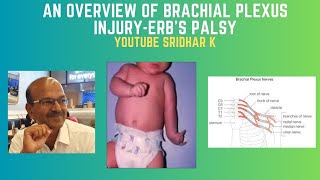 Brachial plexus injuryErbs palsy An overview Erbs palsy brachialplexusinjury [upl. by Fitts198]