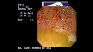 ENDOSCOPIA GASTRITIS EROSIVA NGELMED [upl. by Lubeck502]