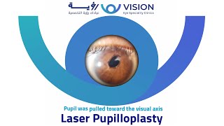 Laser pupilloplasty for updrawn pupil HM to 636 immediately postop [upl. by Milford]